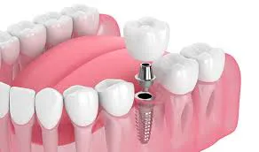 implantes